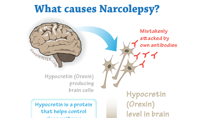 Famous People with Narcolepsy | HRFnd