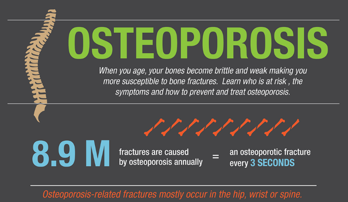 Famous People with Osteoporosis | HRFnd