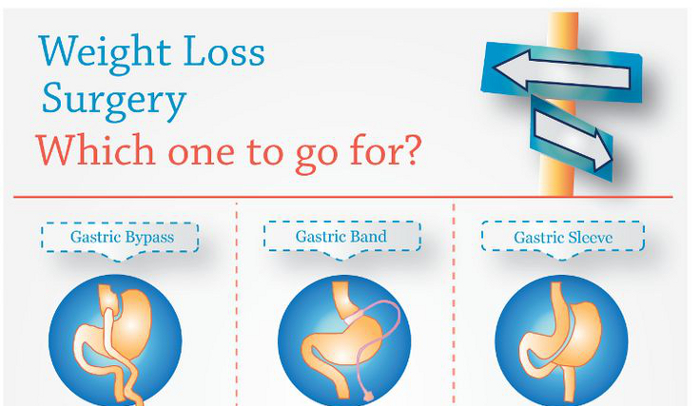 Gastric Sleeve Pros and Cons HRFnd