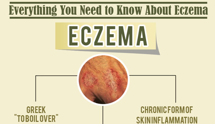 Dyshidrotic Eczema Treatment & Management: Approach ...