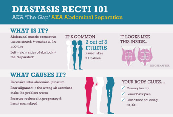 Diastasis Recti Symptoms HRF