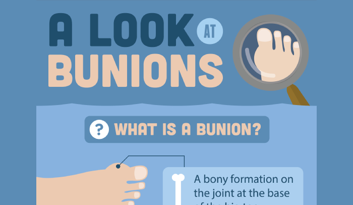 How to Prevent Bunions from Getting Worse - HRF