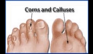 Home Remedies for Plantars Warts