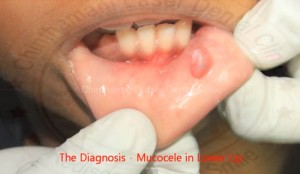 Mucocele Home Remedy Removal & Treatment