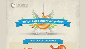 Gastric Sleeve Success Rate