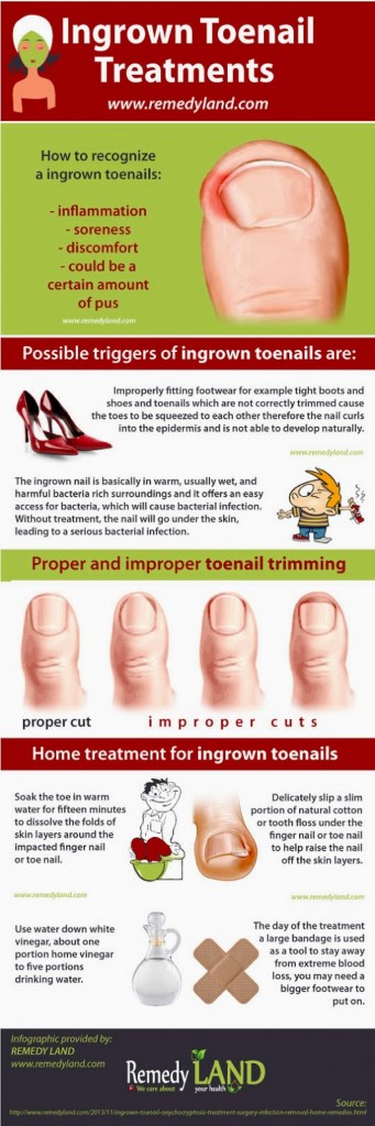 Ingrown Toenails Facts - HRF