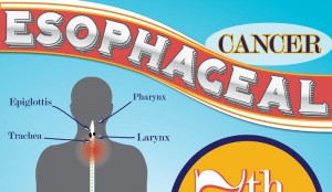 Is Esophageal Cancer Hereditary