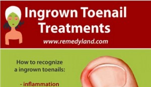 What Causes Ingrown Toenails