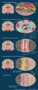 Arachnoid Brain Barrier