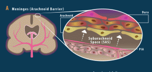 Arachnoid Cyst Symptoms