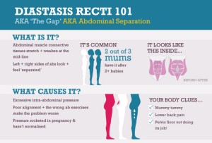 Diastasis Recti Symptoms