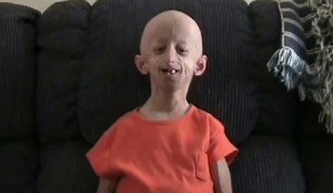 7 Interesting Facts About Progeria