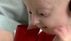18 Amazing Statistics of Progeria