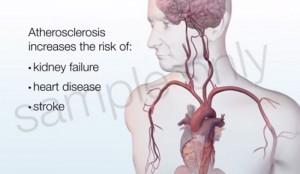 10 Important Facts About Atherosclerosis