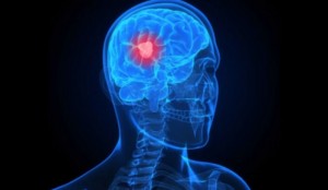9 Interesting Facts About Brain Tumors