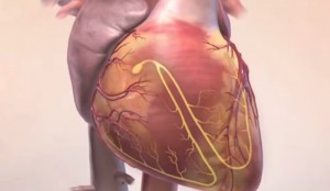 AFIB vs SVT