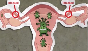 Yeast Infection vs Gonorrhea