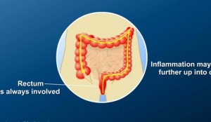 Explanation of Panca Blood Test Results