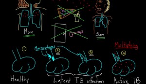 Quantiferon TB Gold Blood Test Results Meaning