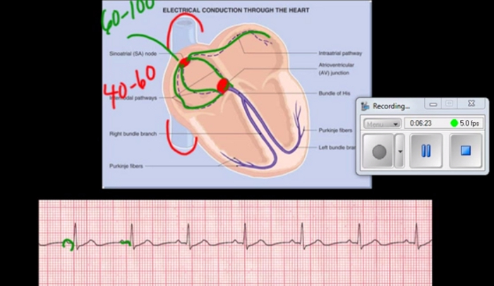 Difference Between Atrial Fibrillation And Atrial Flutter Hrf