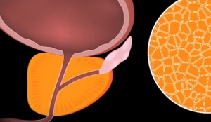 Explanation of BPH Blood Test Results